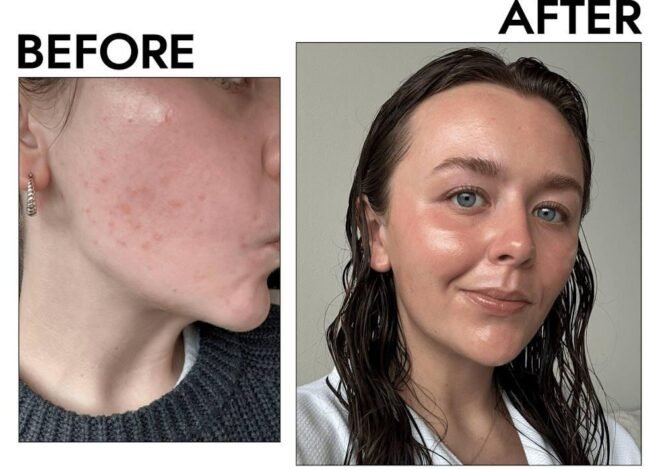 Menarini Tretinoin Gel: Why Users Prefer This Formulation for Acne and Skin Renewal