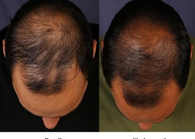 Lonitab (Minoxidil Tablets): Oral Therapy for Hair Loss and Blood Pressure