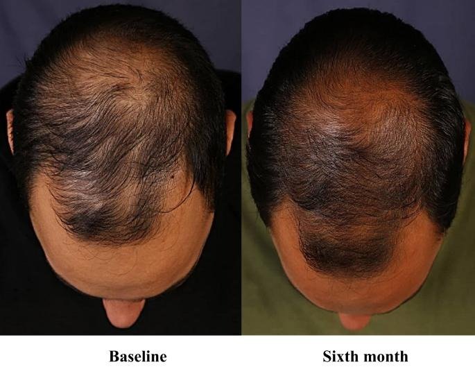 Lonitab (Minoxidil Tablets): Oral Therapy for Hair Loss and Blood Pressure